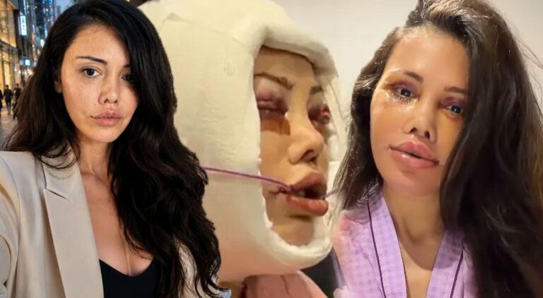 Didem Ceran 15 saatlik operasyonla yüz nakli olmuştu! Kendisini dünyaca ünlü yıldızla karşılaştırdı