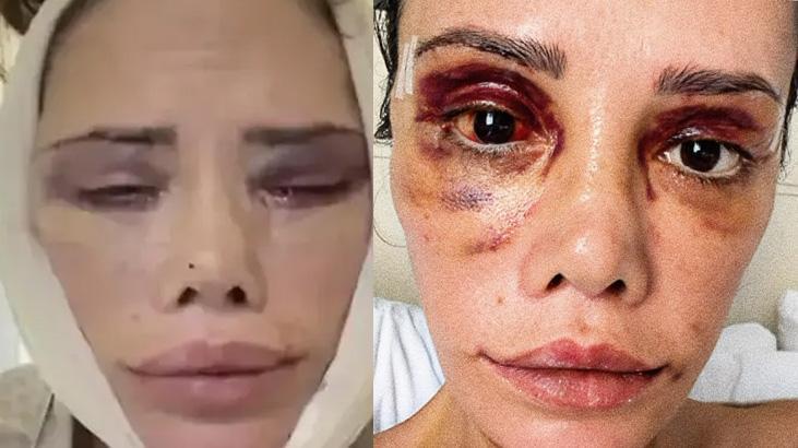 Yüz nakli olan Survivor Didem Ceran son halini paylaştı! ‘Hepinizden çok özür diliyorum’