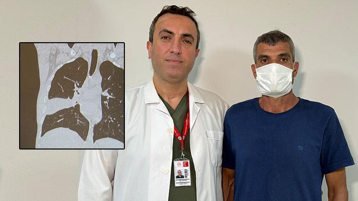 Hastanın akciğerinden kemik çıktı! ‘Kemiği seven biriyim, şaşırtmadı’