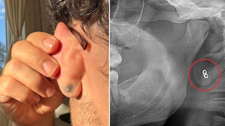 Kulağı 20 yıl önce yeşile döndü! Röntgen sonucu şaşırtıcı: ‘İçeride kalmış’