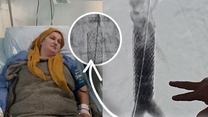 Milyonda bir görülen vaka! Öksürürken kalp damarı yırtılan kadın ölümden döndü