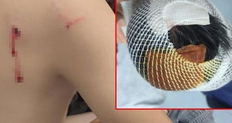 Okul dönüşü köpeklerin saldırdığı çocuğun başına 15 dikiş atıldı